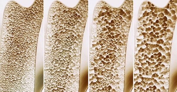 Osteoporosis Osteoporosis