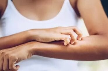 Picadura de mosquito