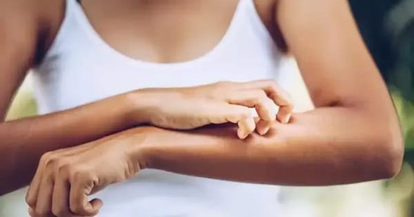 Picadura de mosquito