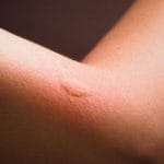 Picadura de mosquito