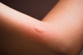 Picadura de mosquito