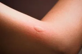 Picadura de mosquito